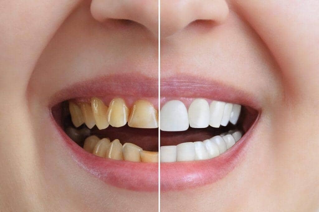Teeth Whitening at Yahshua Medical Clinics