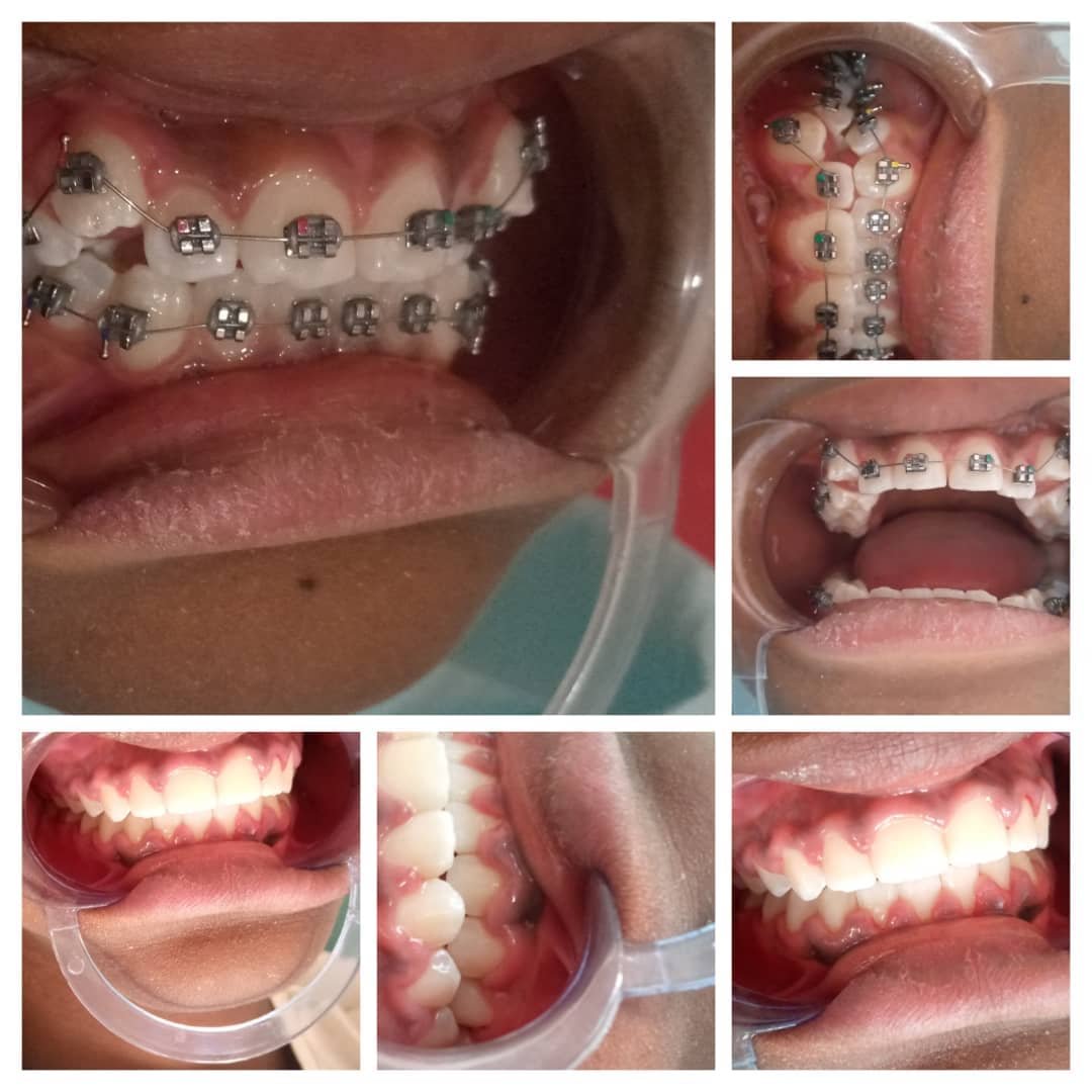 Braces and Orthodontics at Yahshua Medical Clinics