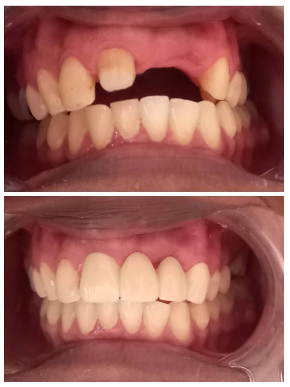 Dentures, Crowns and Bridges at Yahshua Medical Clinics