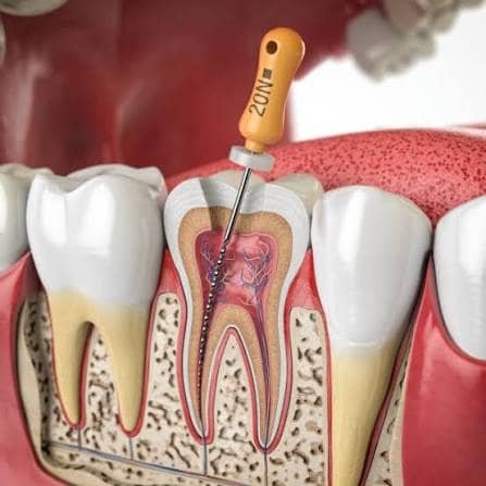 Root Canal Treatment at Yahshua Medical Clinics